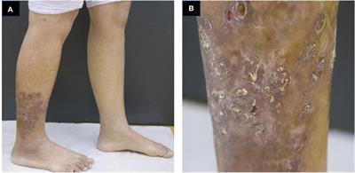 Case report: Rubella virus-associated cutaneous granuloma in an adult with TAP1 deficiency